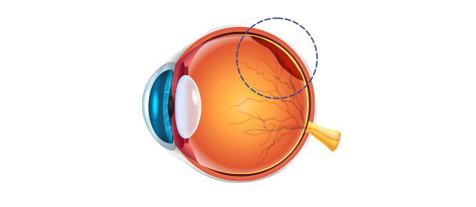 견인성 망막박리