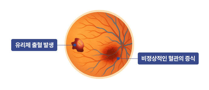 증식성 당뇨망막병증