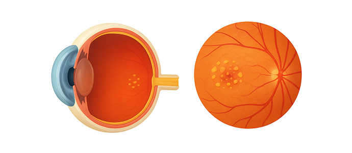 비삼출성(건성) 황반변성