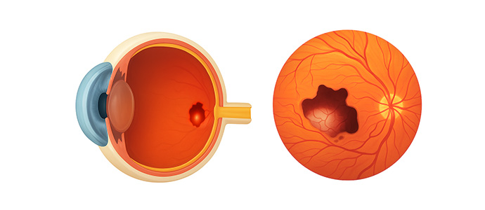 삼출성(습성) 황반변성