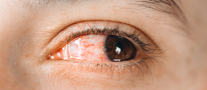 눈물 증발 과다형 안구건조증