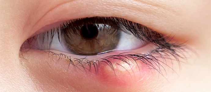 후안검염(마이봄샘 기능 장애)