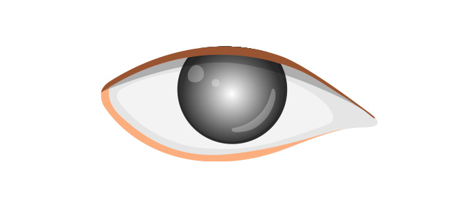 이차 녹내장 동반 백내장