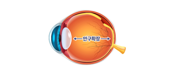 황반부 망막층간분리증