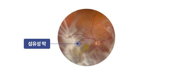 증식유리체망막병증