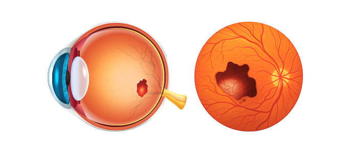 근시성 맥락막 신생혈관 (고도근시성 황반변성)