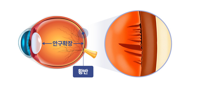 근시성 견인 황반병증