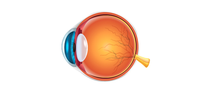 고도근시성 망막박리